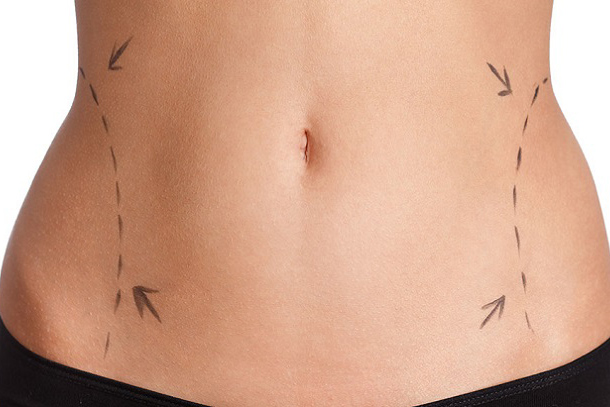 abdominoplastia